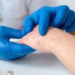 Studie-Kraetze-SCABIES-Wuppertal