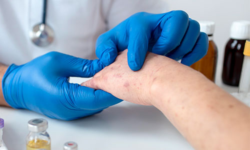 Studie-Kraetze-SCABIES-Wuppertal